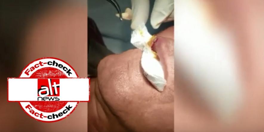 Video of Parasite Removal from a Person s lip Falsely Linked With